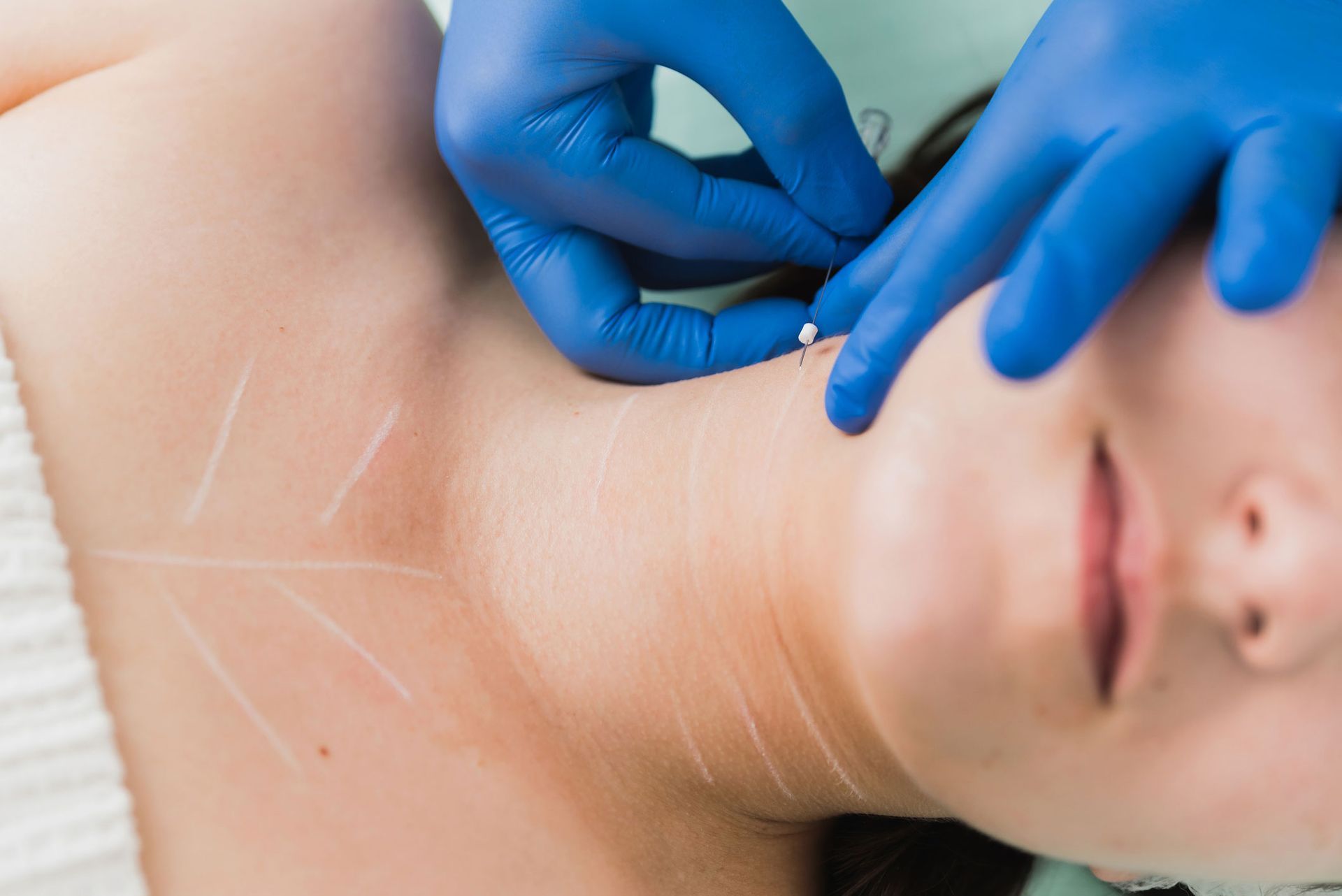 Person receiving a cosmetic procedure on their neck, gloved hands hold a needle, white lines mark the skin.