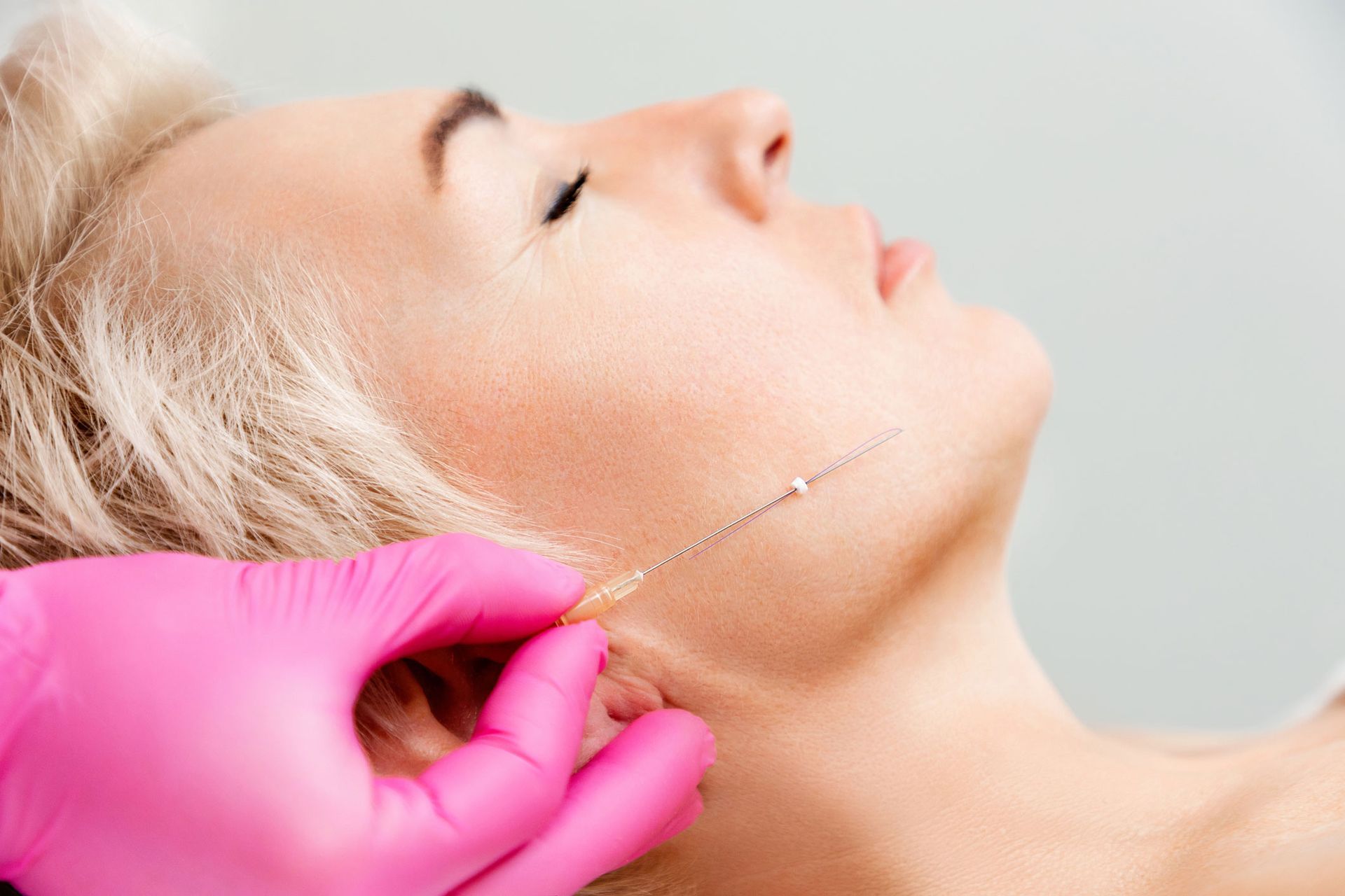 Person receiving cosmetic thread lift, pink gloved hand.